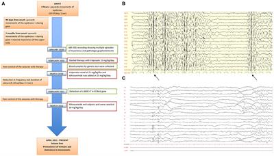 Myoclonic Epilepsy: Case Report of a Mild Phenotype in a Pediatric Patient Expanding Clinical Spectrum of KCNA2 Pathogenic Variants